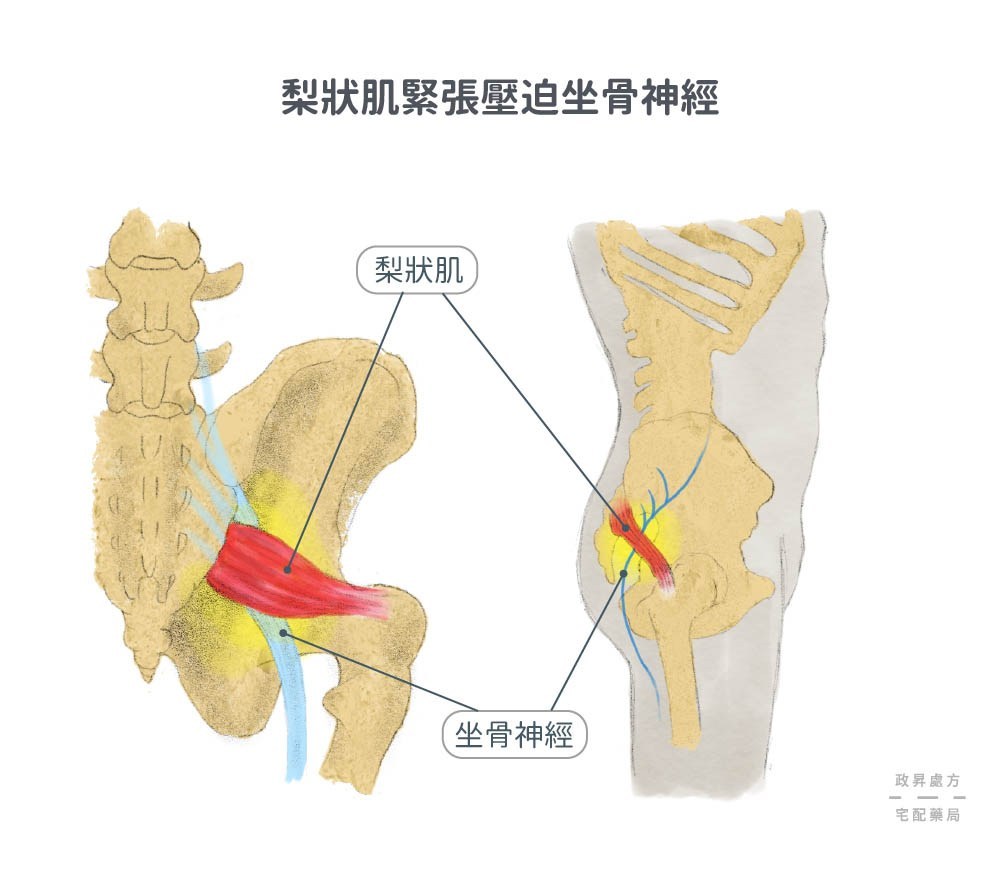 假性坐骨神經痛與梨狀肌緊張